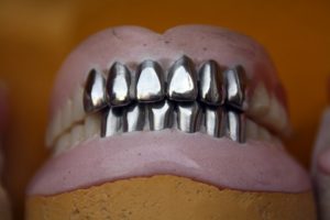 https://clinident.hu/kezeles/porcelan-hej-korona/